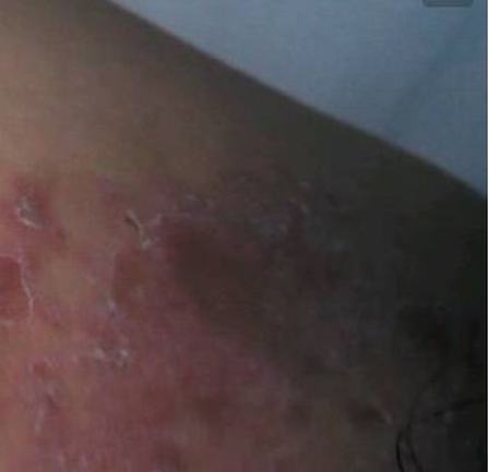 股癣的病因及发病条件