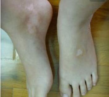花斑癣的发病因素是什么