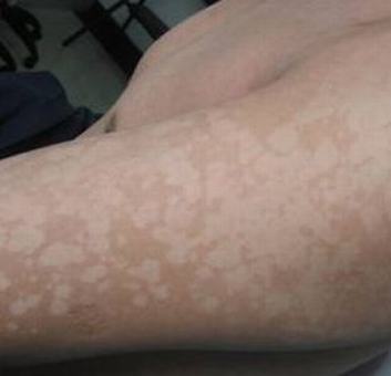 花斑癣的分类及其症状