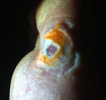 鸡眼病因和症状