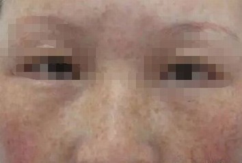 青岛皮肤病医院治雀斑