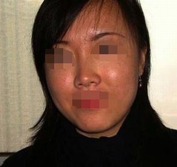 脸上雀斑越来越多怎么办