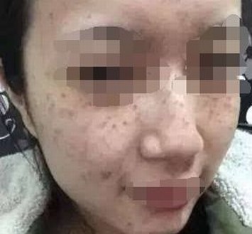 脸上雀斑怎么治