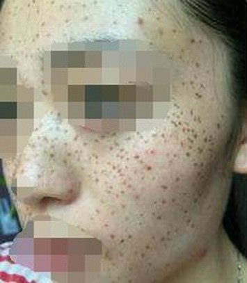 脸上雀斑 怎么治