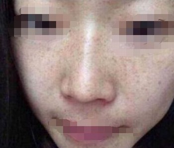 不做斑点女 预防雀斑从生活细节开始 