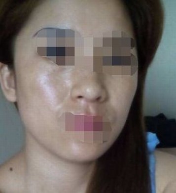 女性雀斑有碍瞻观怎么办呢