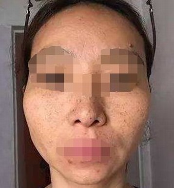 女性盐吃多了也可能是长雀斑的原因啊