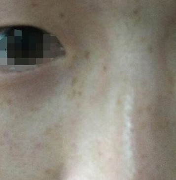 女性盐吃多了也可能是长雀斑的原因