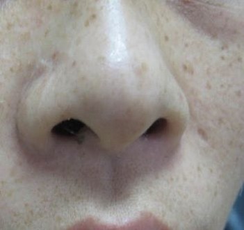 除掉雀斑的有效措施是什么