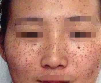 什么是雀斑皮肤
