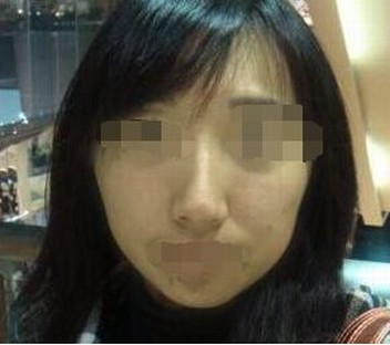何谓雀斑皮肤啊