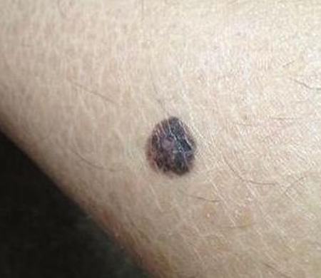 青岛色素痣的激光治疗_色素痣