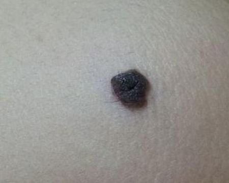 色素痣的症状你了解吗？