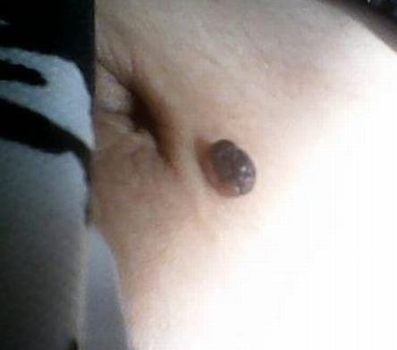色素痣是如何产生的