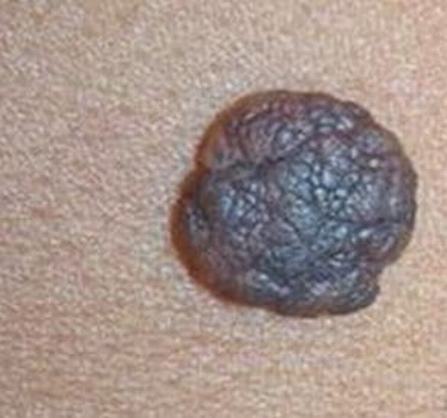 黑色素痣激光除掉_色素痣