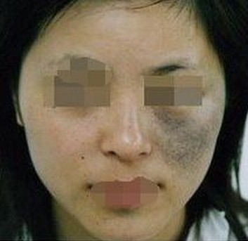 青岛如何治疗脸上的太田痣