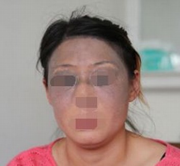 青岛什么措施治疗太田痣有效果 