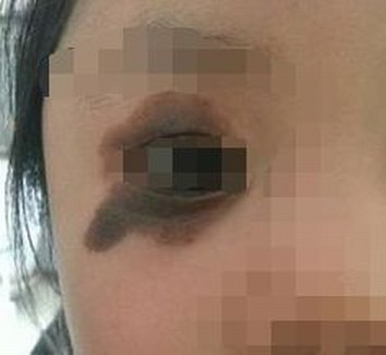 青岛使用激光治疗太田痣成功率高吗