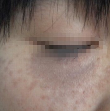 太田痣的两大危害
