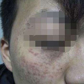 青岛激光治疗的手法治疗太田痣