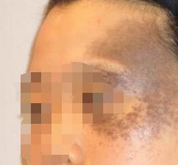 除掉太田痣的价格