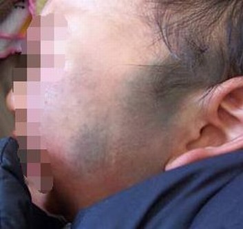 如何将太田痣与其他疾病区分开