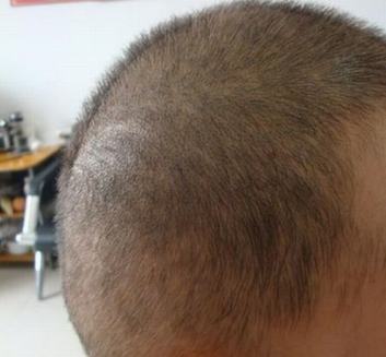 男人脱发八招帮你解决扰