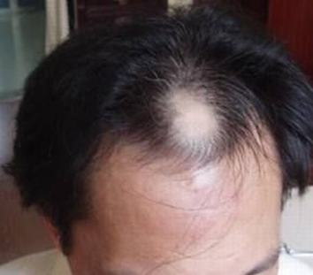 女性脱发的原因都有什么呢