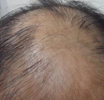皮肤病专科医生解析:脱发的7个等级症状