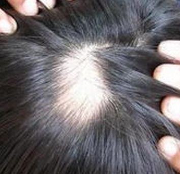 青岛女性植发治疗脱发以后怎样护理 