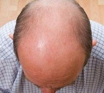 导致男性脱发的具体原因_脱发