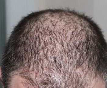 导致严重脱发的原因是什么