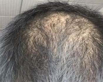 冬季怎样预防脱发脱发的具体病因都有什么呢