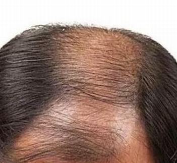 婚后男性脱发越来越严重