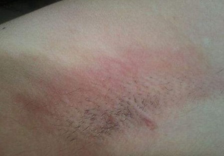 青岛治疗腋臭哪里好