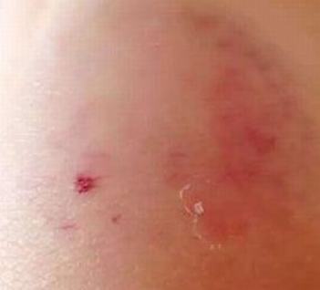 女性寄生性阴虱的症状