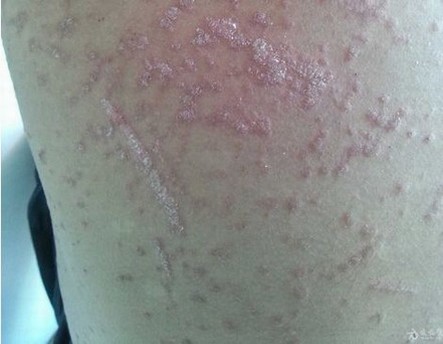 全国银屑病健康管理救助示范基地应时而生