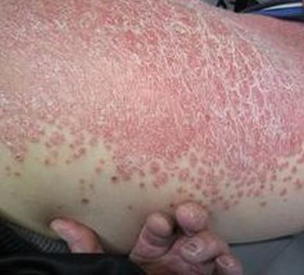 恼人的银屑病终于治好了
