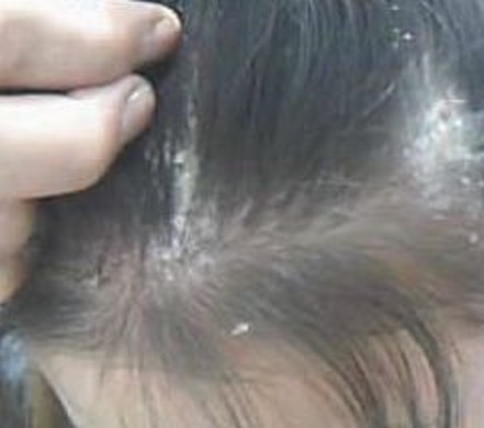 青岛各型银屑病都如何治疗