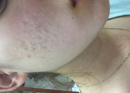 脸上粉刺分布部位的不同