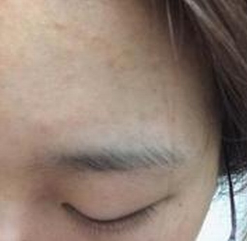 粉刺的发病的部位不同