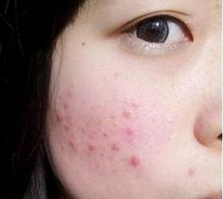 痤疮粉刺暗疮三者的区别和防护