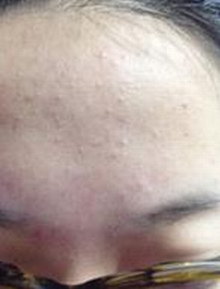大学生满脸粉刺 中西合一很凑效
