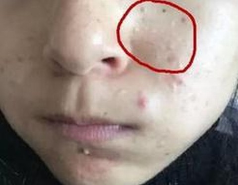 粉刺治疗要求有哪些要注意呢