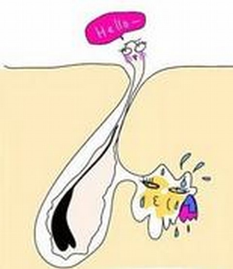 脸上一直长粉刺怎么回事