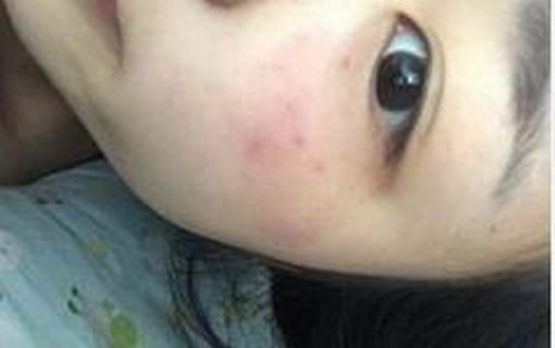 手部过敏发红怎么办