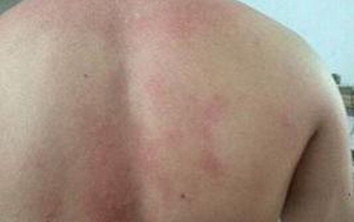 紫外线过敏的症状是什么