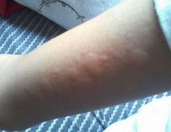 有慢性过敏性鼻炎如何治疗