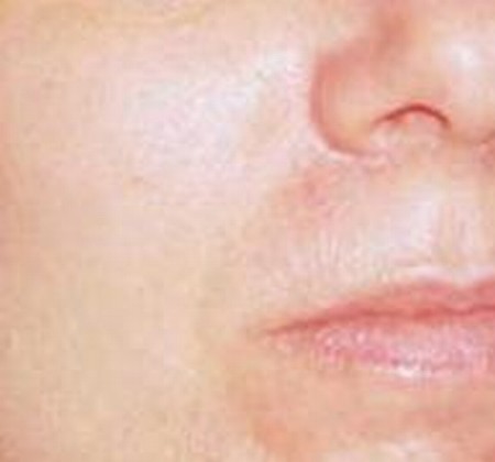 患上过敏性鼻炎的并发症是什么