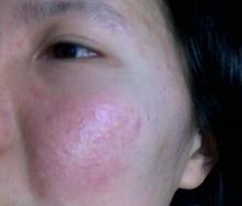 脸过敏用什么化妆品
